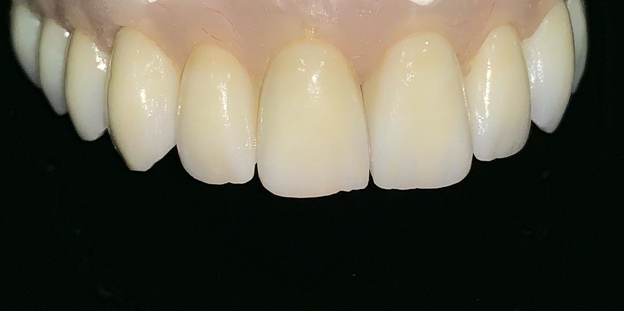 Zircônia Laboratório Ranieri