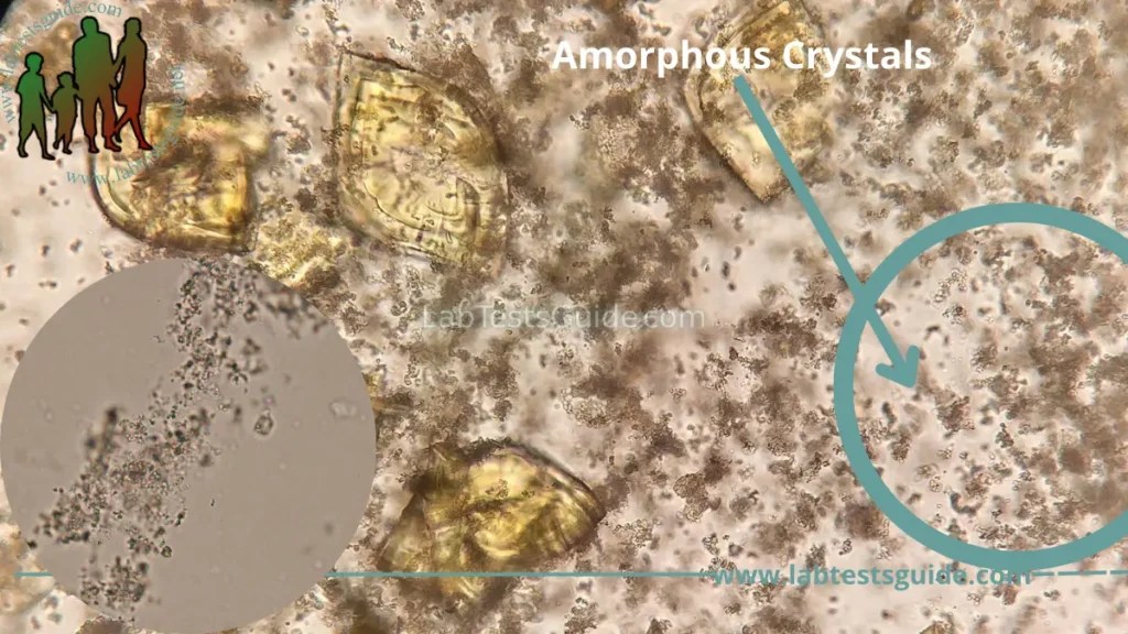 Amorphous Phosphate Crystals In Urine