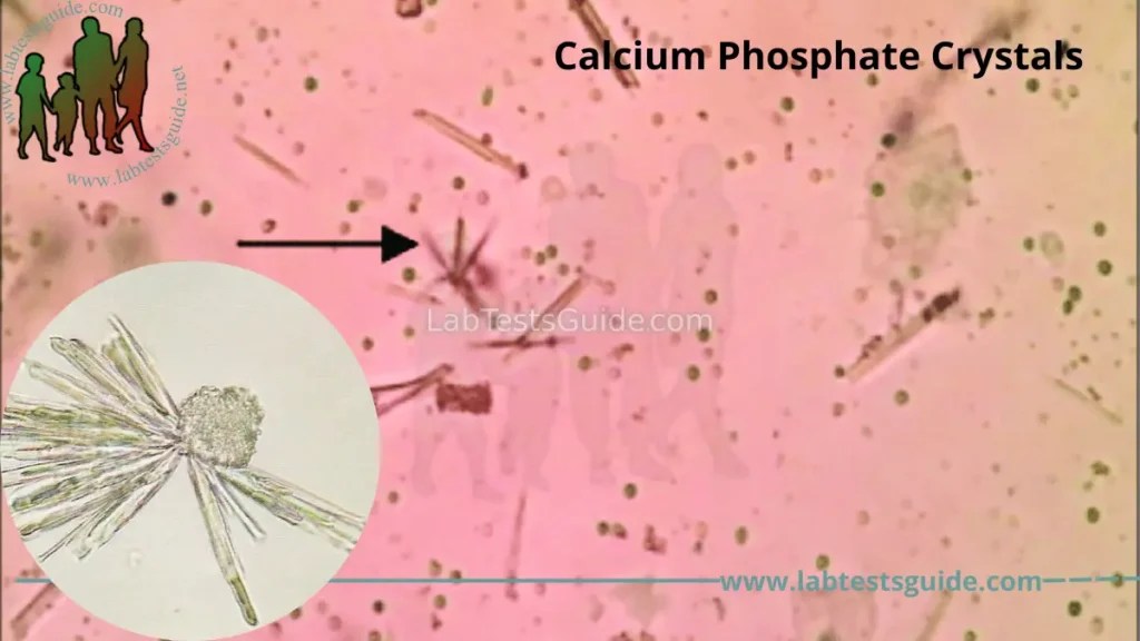 Amorphous Phosphate Crystals In Urine