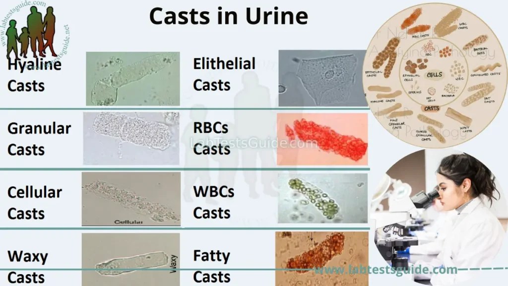 Casts in Urine Lab Tests Guide