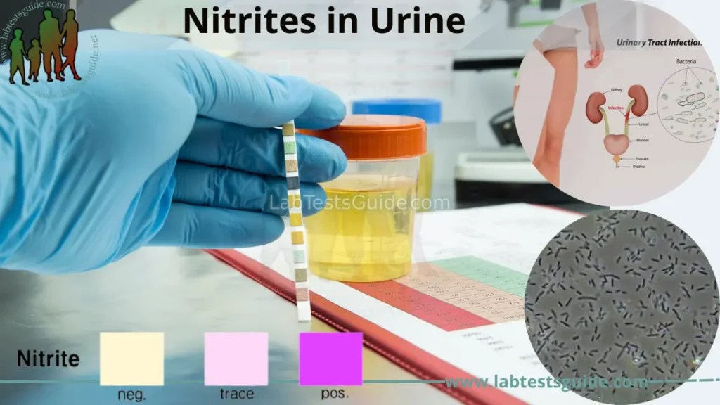 Nitrites in Urine Test Overview, Procedure, Results Interpretation