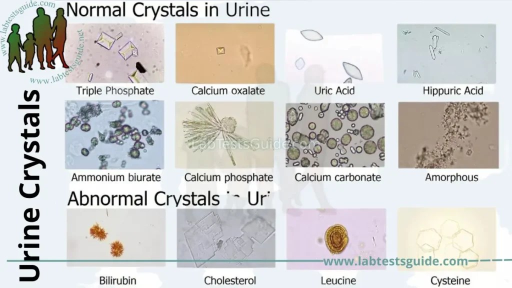 Bilirubin Crystal In Urine
