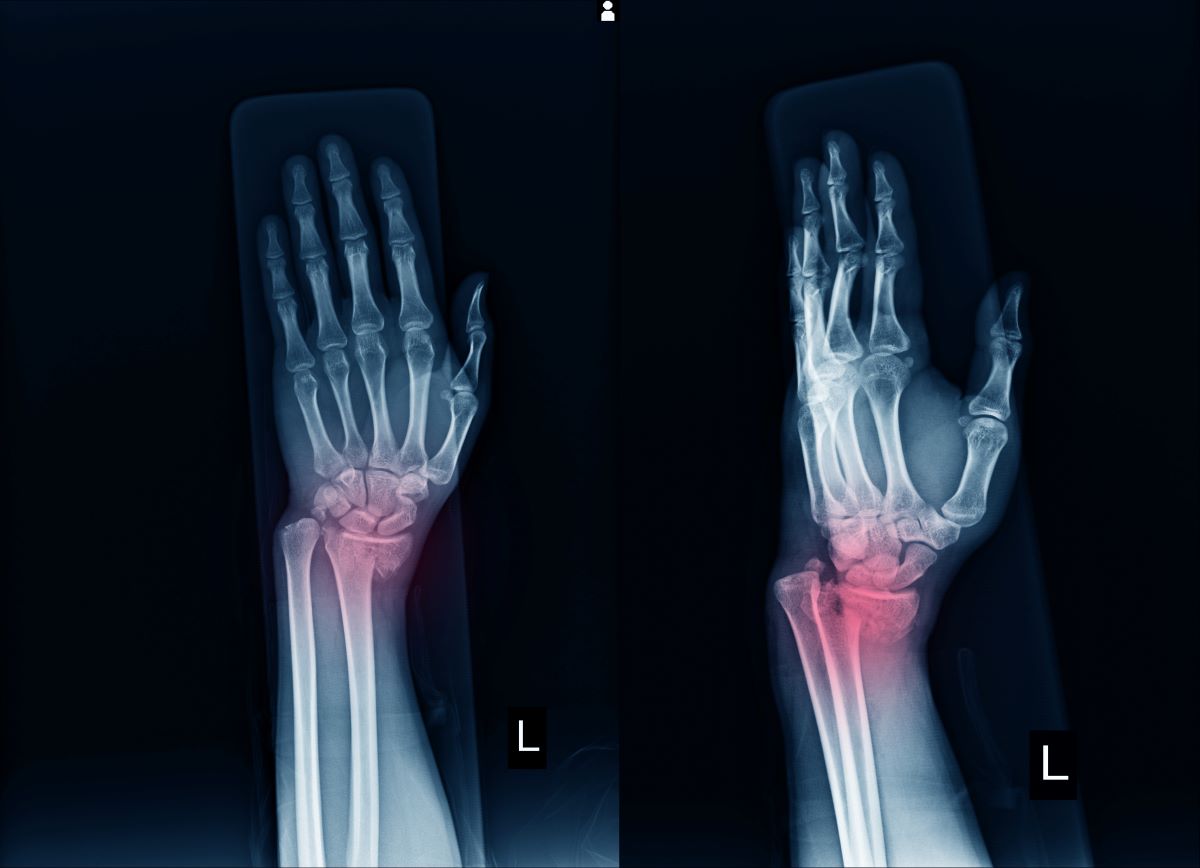 Wrist Fracture Treatment Ladan Hajipour Orthopaedic Surgeon