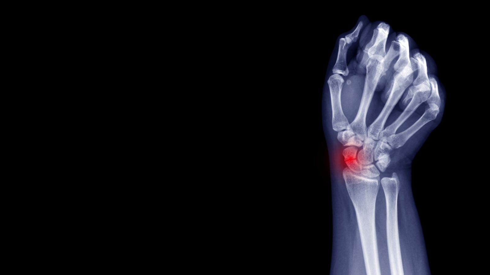 Untreated Scaphoid Fracture What Happens? Ladan Hajipour