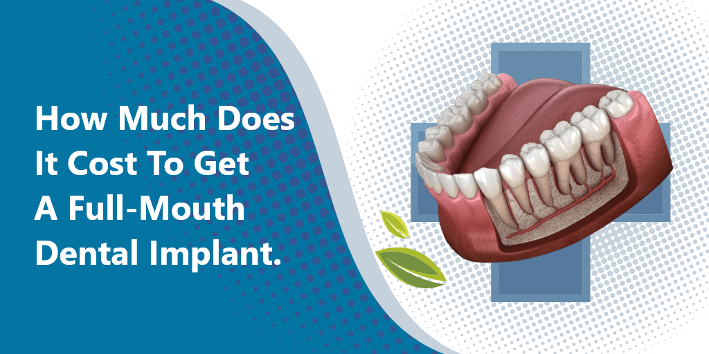 How Much Does It Cost To Get A FullMouth Dental Implant? LA Dental Clinic