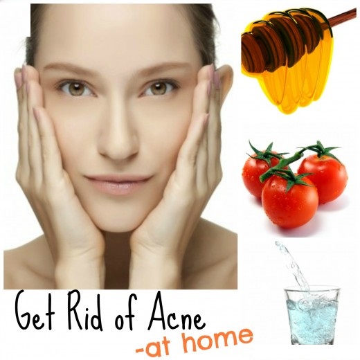 How to Get Rid of Pimples at Home ladiessolutions