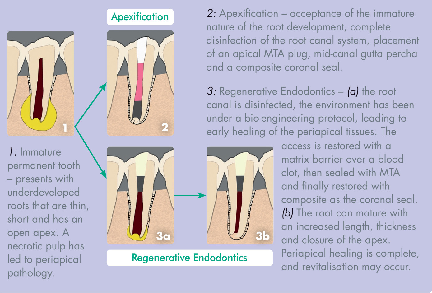 Apexification Near You Vital Pulp Therapy in Tarzana