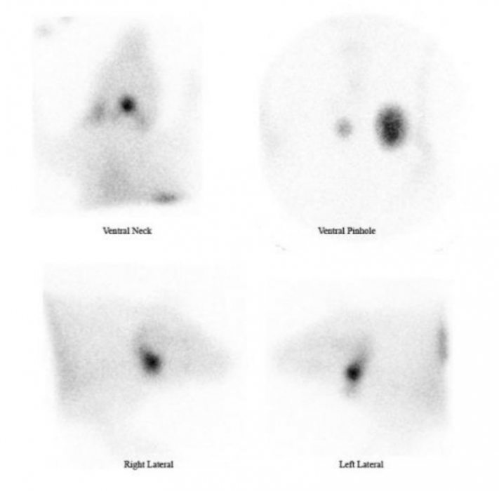 AEMVLafeber Case Report Hyperthyroidism Treated with Radiation