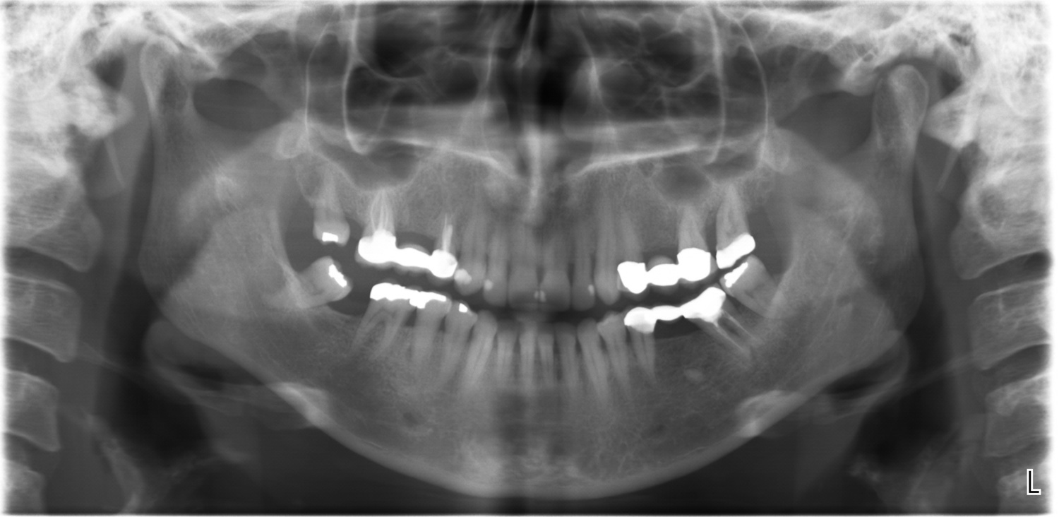 Los Angeles Panoramic XRay Best Advanced Dental Imaging