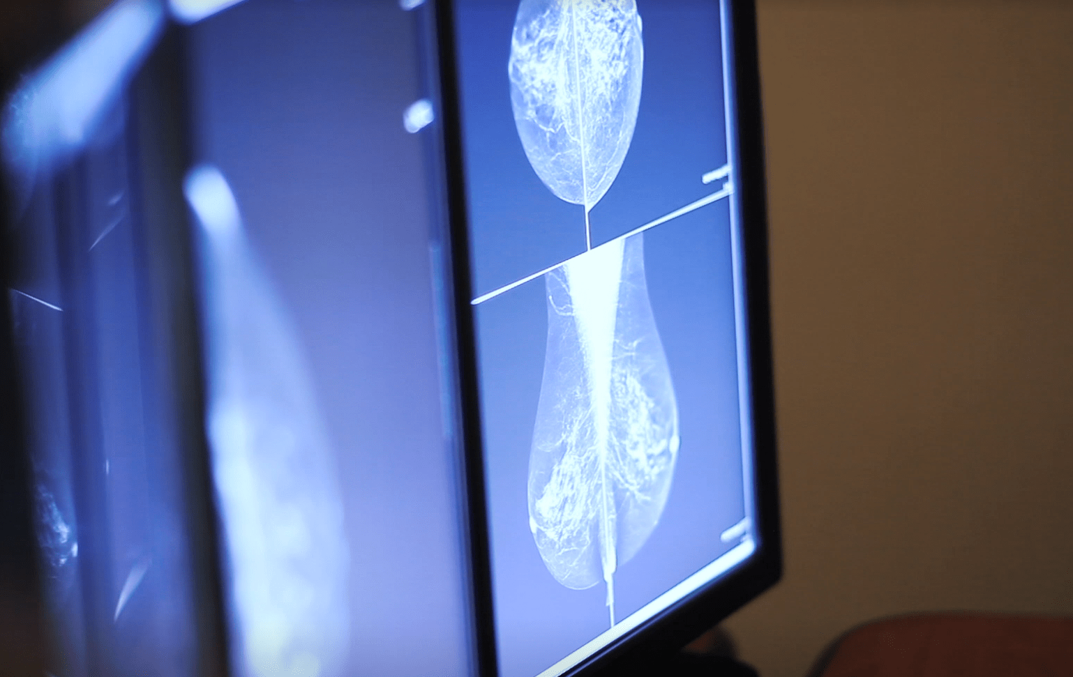 Breast Density Video Lake Medical Imaging The