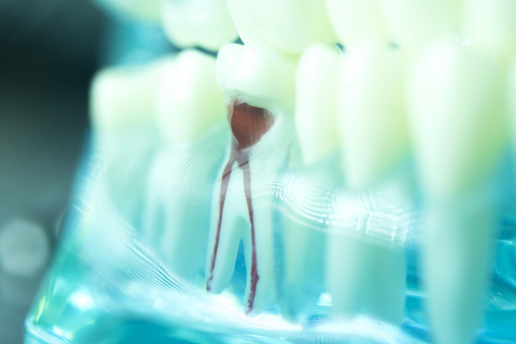 Root Canal Lakeside Dental Designs