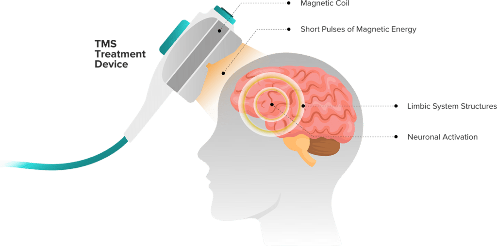 TMS Therapy Carrollton, TX Lakeside Life Center