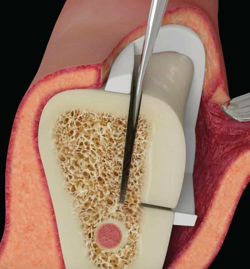 What is autogenous bone harvest for implant reconstruction? La Mesa
