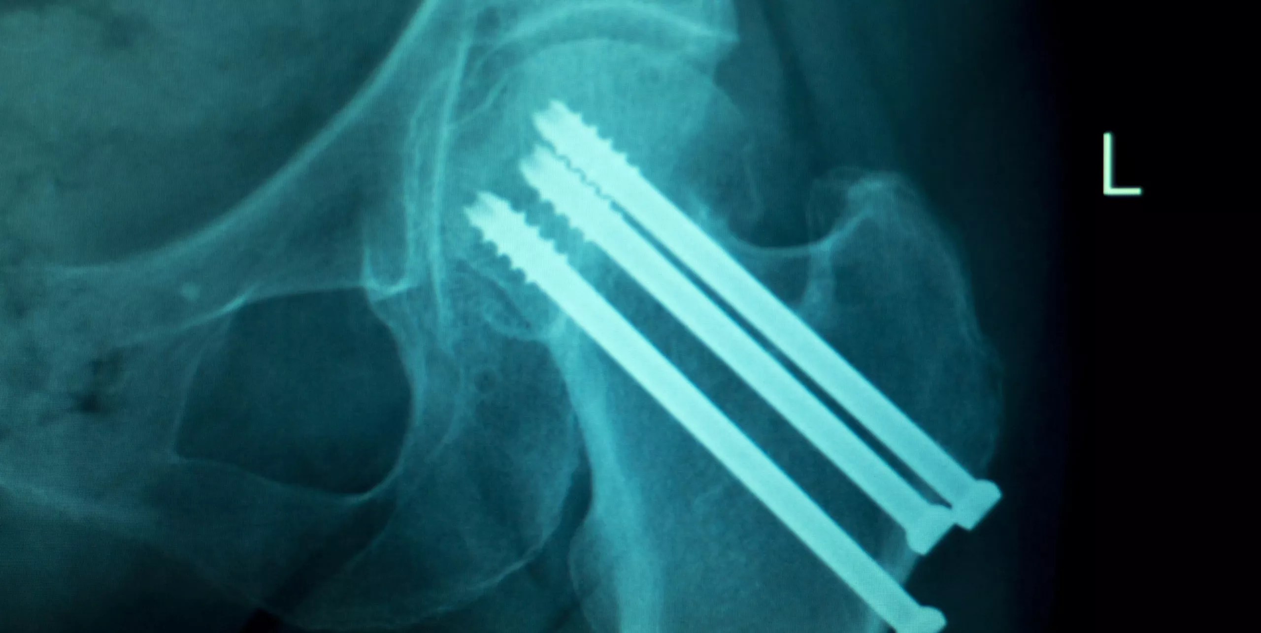 Injuries Caused by Medical Device Plate and Screw Products Lamothe