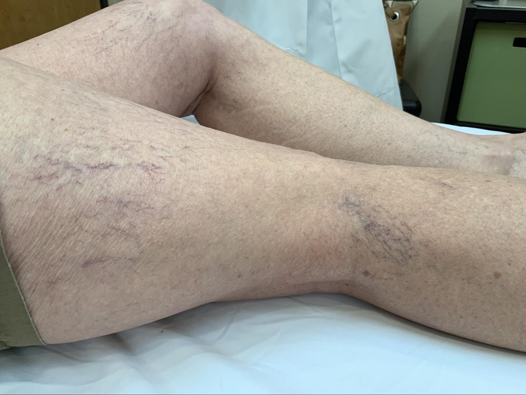 Laser Spider Vein Removal Lani Laser