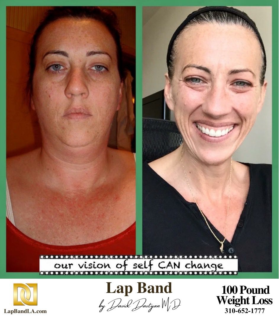 Lap Band surgery Before & After by Dr. Davtyan at Davtyan Medical