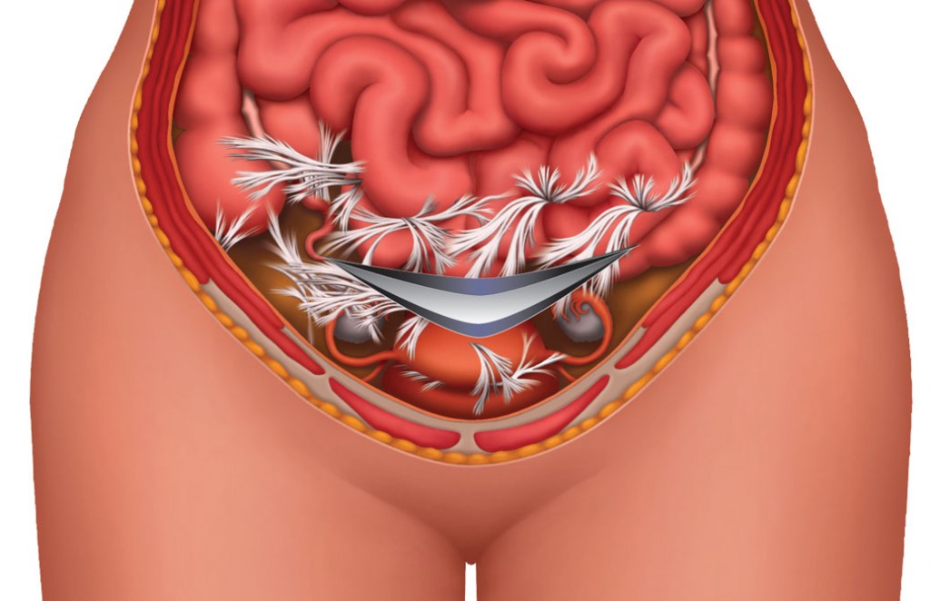 How to Tell if You Have Adhesions After CSection ( CSection Scar