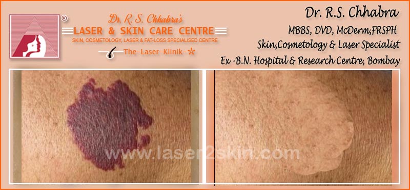 laser 2 skin Tattoo, Birth Marks, Freckles, Dark Eye, Hyper