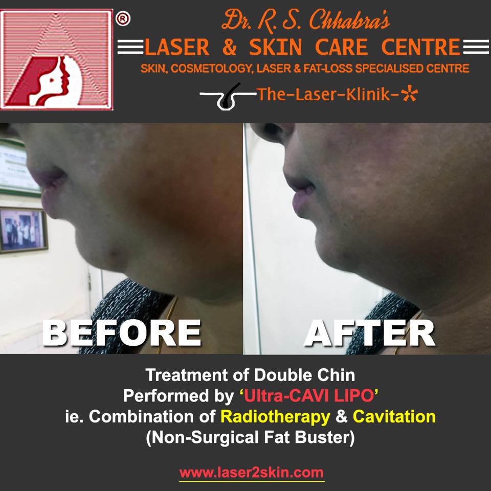 laser 2 skin Puffy Eyes, Wrinkles, Face Tonning, Double Chin, Tummy Reduction Cosmetic