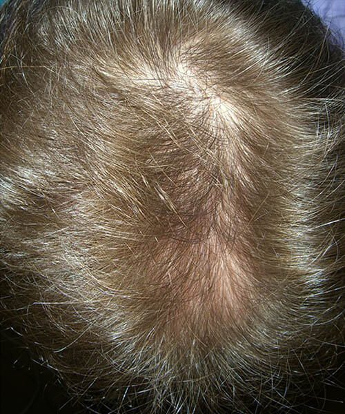 The Original LaserCap for Hair Regrowth Restore Your Hair