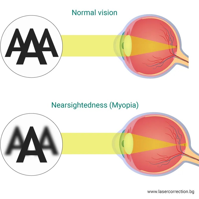 Nearsightedness (Myopia) causes, symptoms, treatment