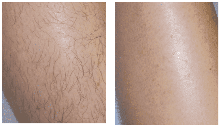 Leg Hair Removal The Doctors Laser Clinic in Norwich