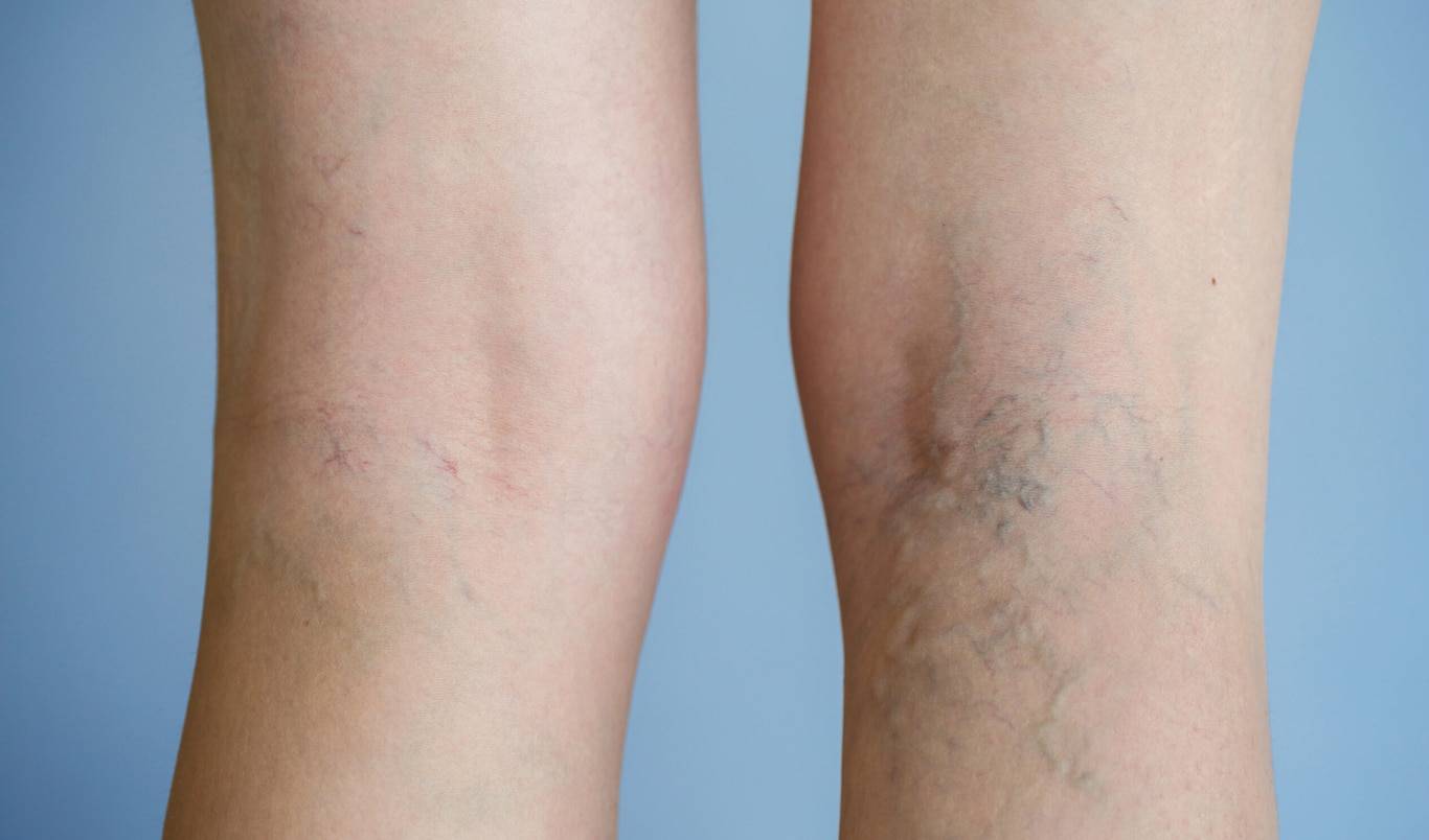 Thread Vein Removal Norwich Expert Laser Vein Treatment
