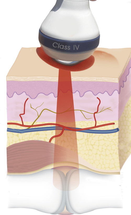 Laser Therapy Laser Joint Centers