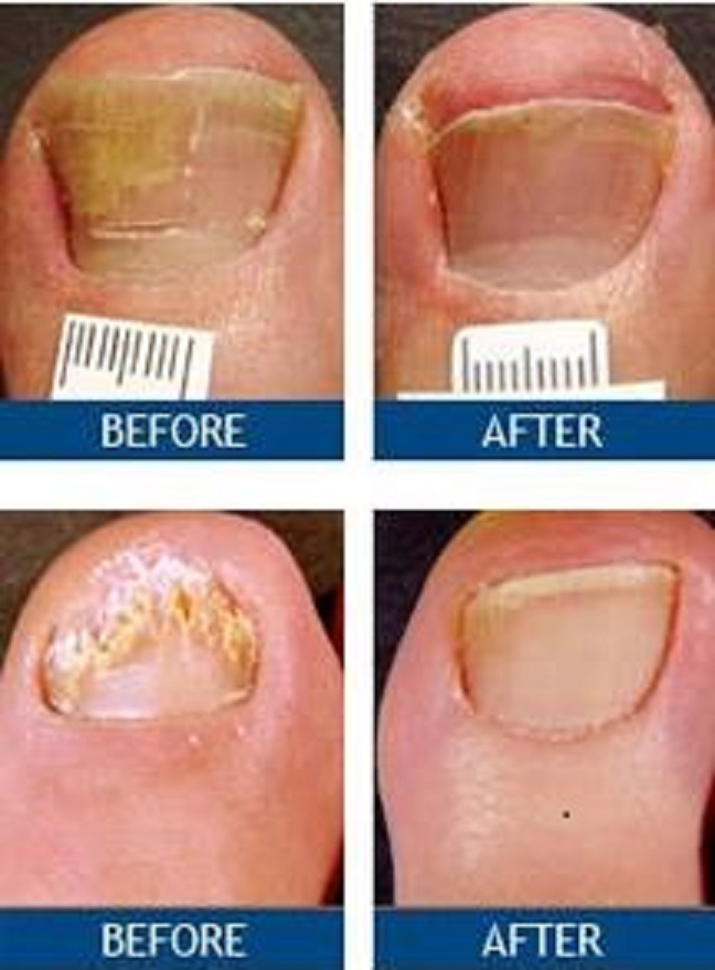 Nail Fungus Treatment Timeline Toenail Fungus Treatment Center