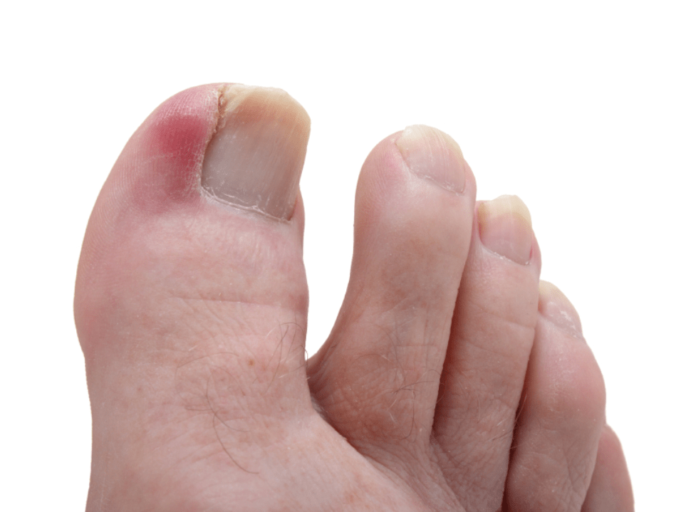 Ringworm vs Nail Fungus Toenail Fungus Treatment Center