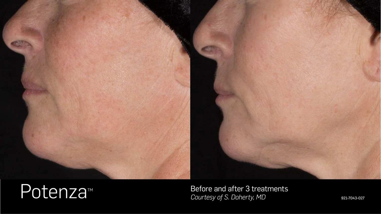 The Top 10 Questions Answered About RF Microneedling LASERSKIN.CA