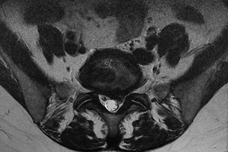 Percutaneous Laser Disc Training Center Dr. Gian Paolo