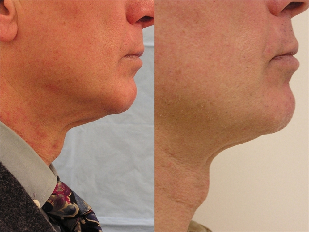 Reduce Fat with Kybella Washington, DC Center for Laser Surgery