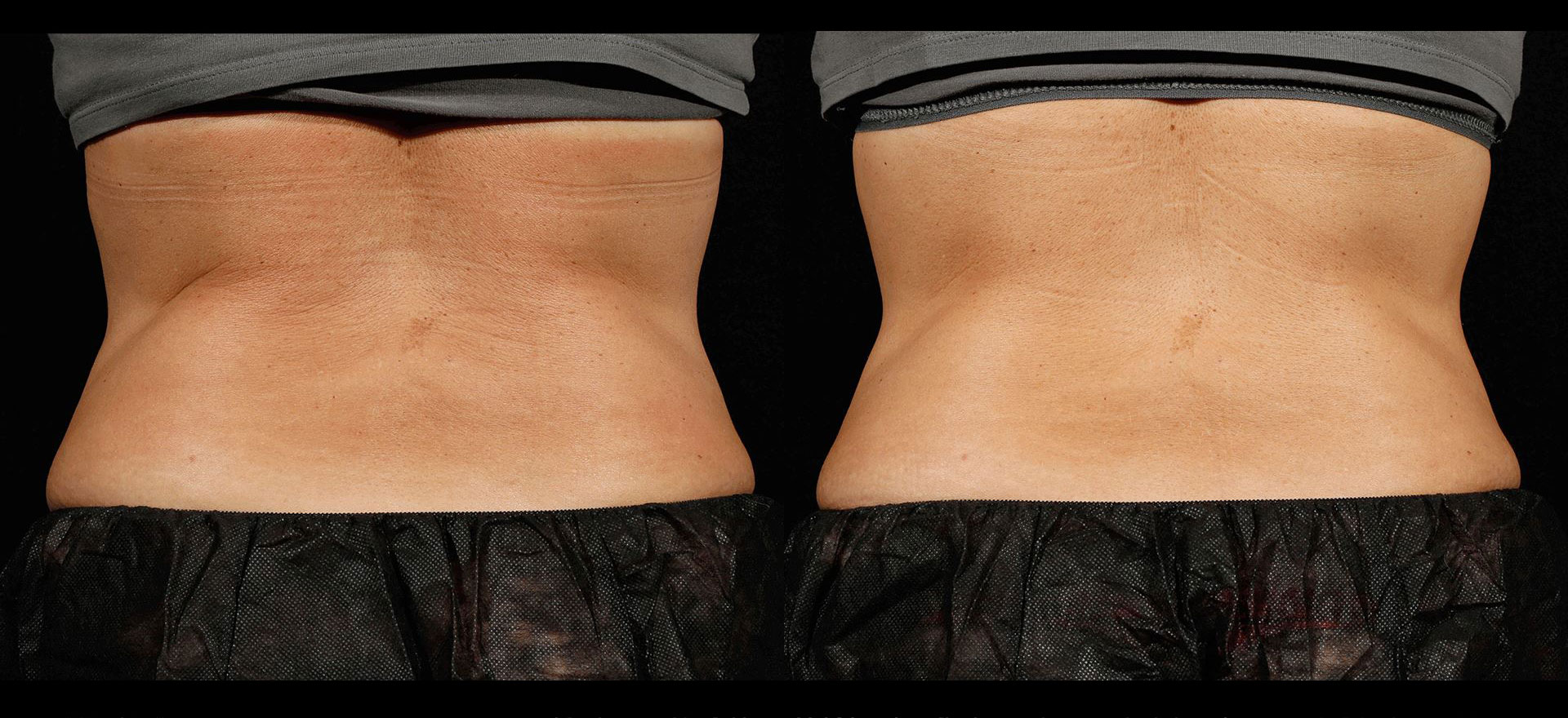 Before and After SculpSure™ Laser The Fat™ Los Angeles, CA Fat Loss