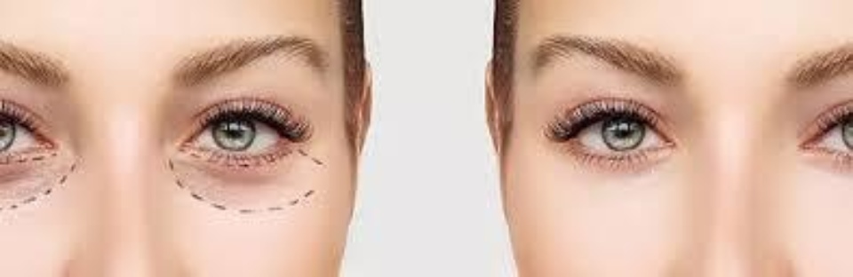 Laser Therapeutics Eye (Lower) Lid Skin Tightening