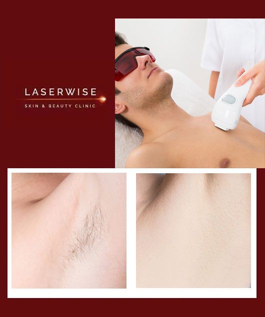 Laser Hair Removal LaserWise Skin Clinic