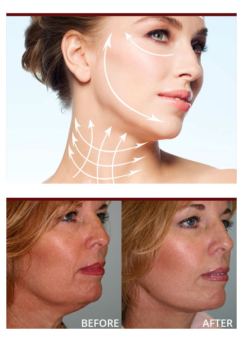 Non Surgical Face Lift Cardiff CACI LaserWise Clinic