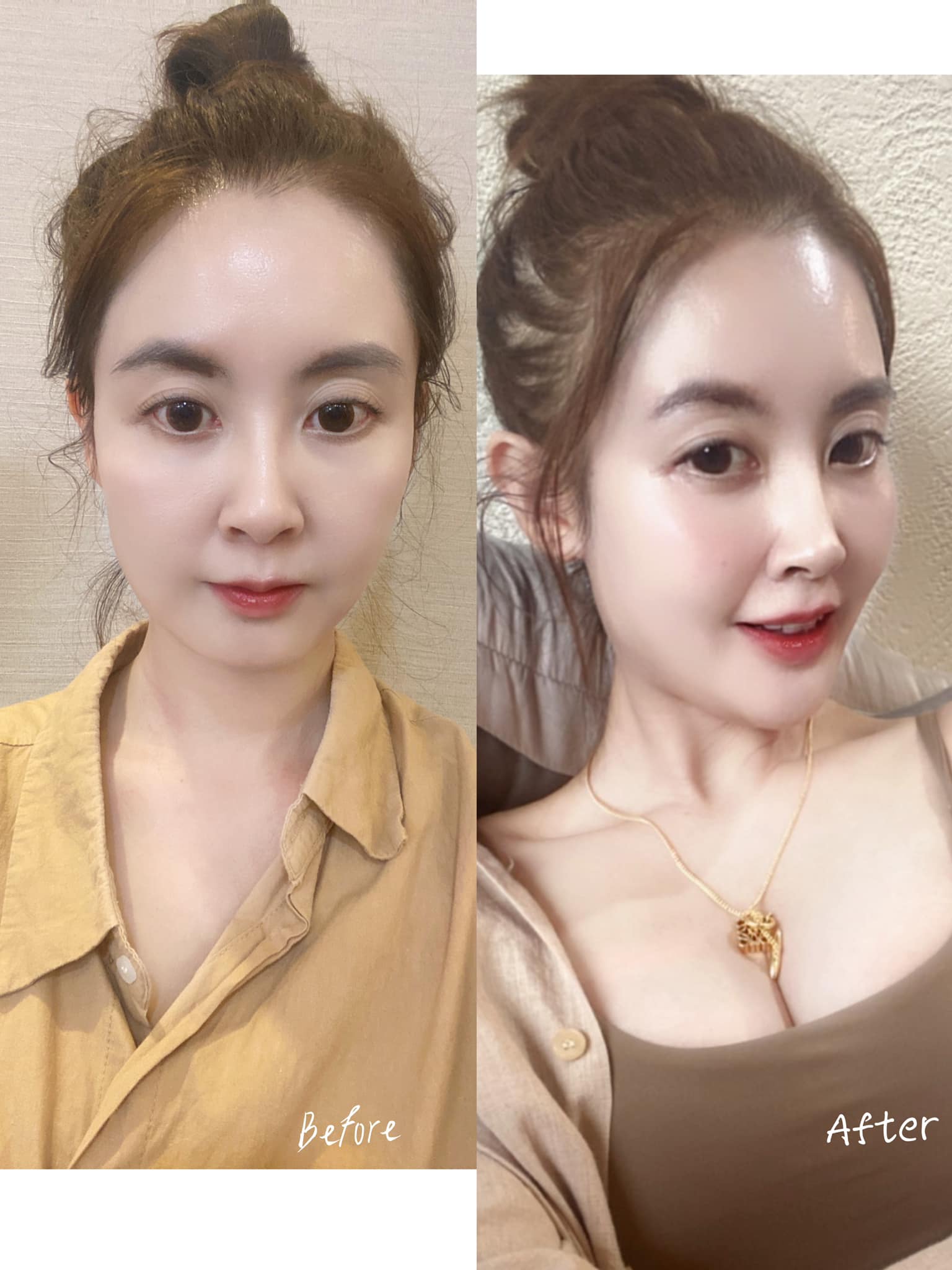 星和醫美診|V臉小秘密 ，喬雅登玻尿酸-劑型:VOLUMA 1CC