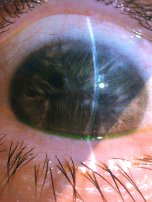 Eye Color Change Surgery Gone Wrong Eye Color Photos