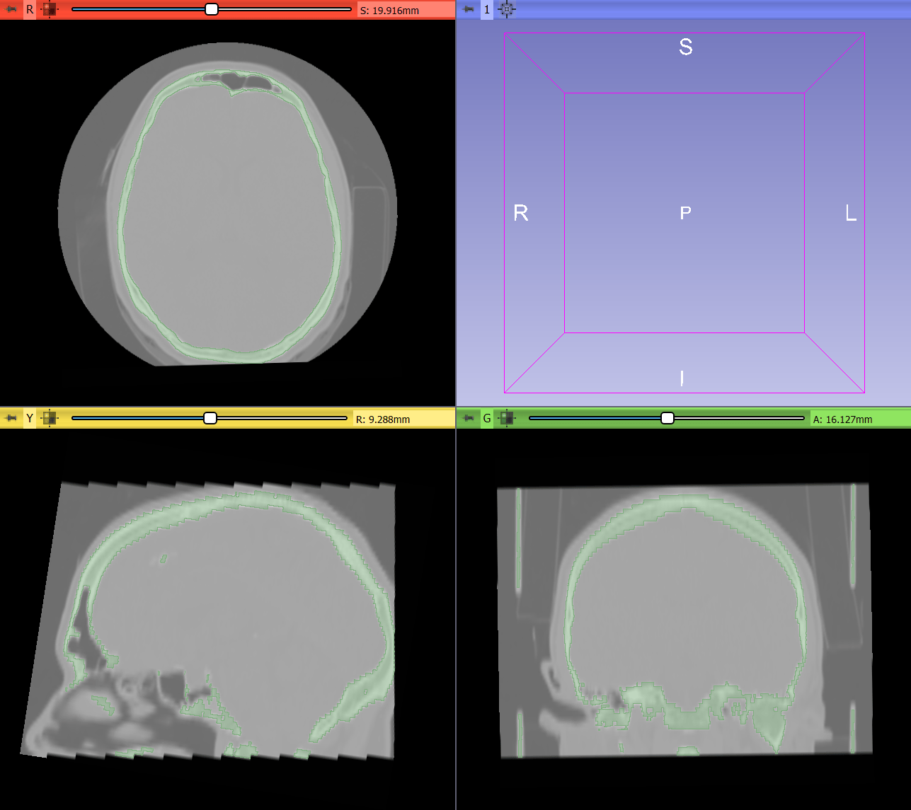 Overview 3D Slicer segmentation recipes