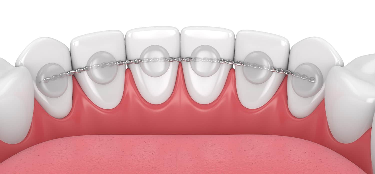 Permanent Retainers Expectations vs. Reality Orthodontist Raleigh NC