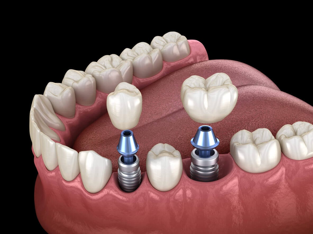 PeriImplantitis and How It Can Affect Your Dental Implants Lasting