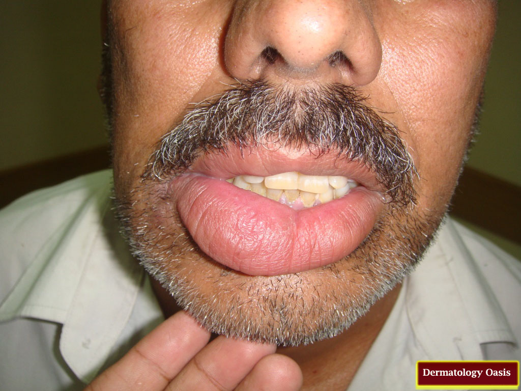 Гландулярный хейлит что это такое, симптомы, признаки и лечение