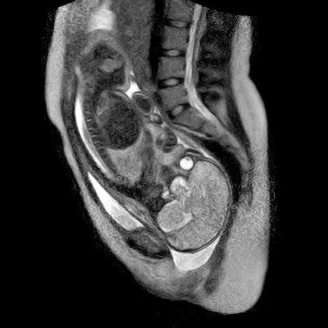 First MRI Video of a Human Birth Taken in RealTime Released