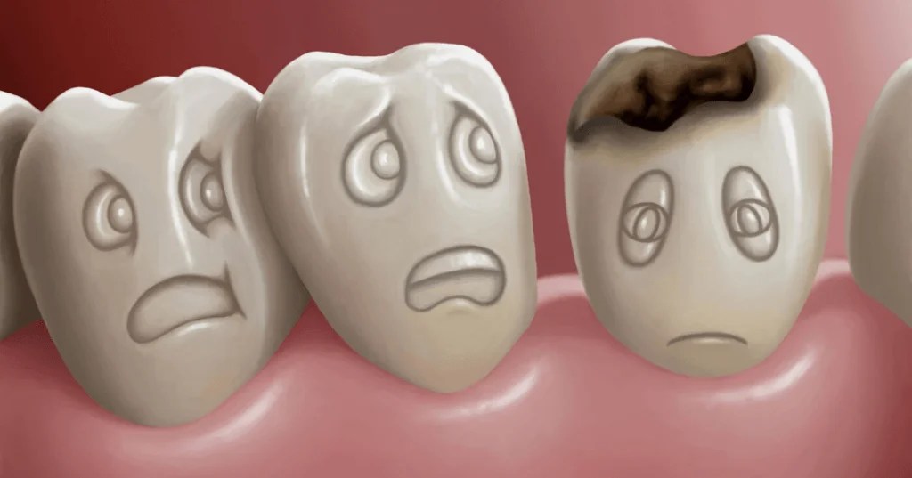Tooth Decay Causes, Symptoms, Diagnosis & Treatment Lavanya Dental Clinic