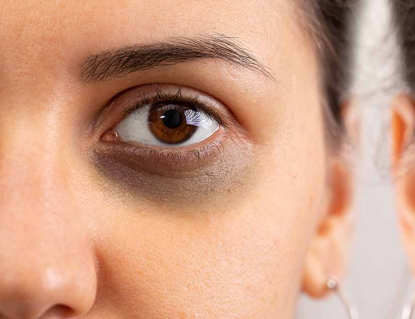 Hilfe bei blauen Augenringen Lavule