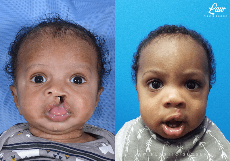 Cleft Lip Repair, Primary Unilateral Before & After Photos Law
