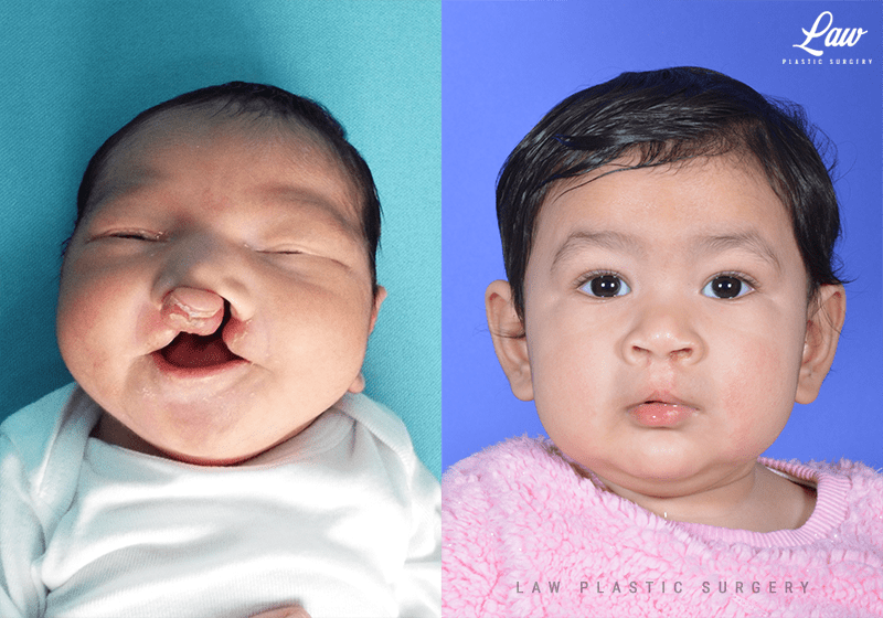 Cleft Lip Repair, Primary Bilateral Before & After Photos Sage