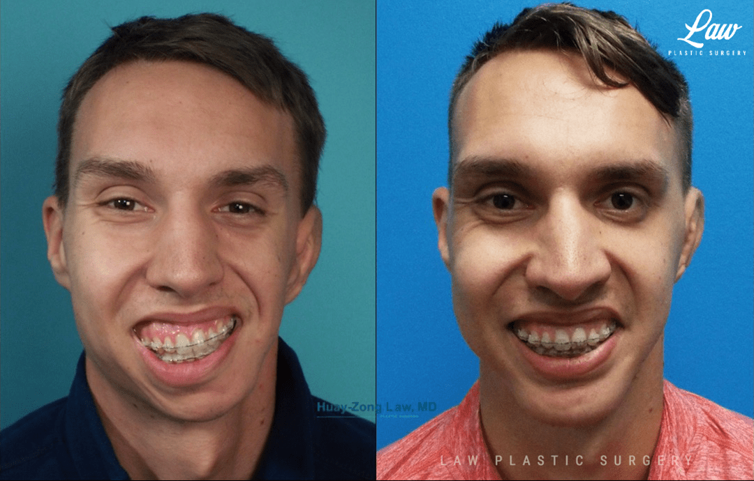 Hemifacial Microsomia / Goldenhar Syndrome Before & After Photos Sage