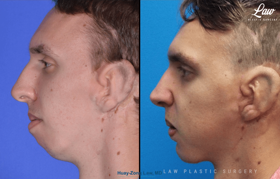 Jaw Surgery Before & After Photos Sage Plastic Surgery